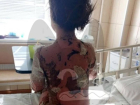 У семилетней девочки отслоилась кожа после лечения под Воронежем