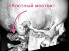 Жила в аду 15 лет: воронежские нейрохирурги освободили мозг девушки от костного плена