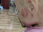 «На теле малышки 19 укусов»: мальчик покусал девочку в детском садике в Воронежской области
