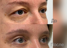 "Круговая" блефаропластика (верхняя+нижняя)  в клинике "Доктор Альбрехт"