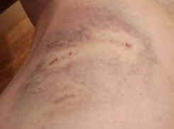 Собака напала на ребенка по дороге домой в Воронеже