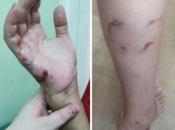 «Заберите, чтобы потом не плакать»: дочь укушенной женщины в Воронеже намерена вызвать отлов собак 