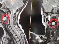 Редкую операцию провели пятилетней девочке в Воронеже 