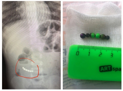 Проглотившего магнитные шарики 5-летнего мальчика спасли врачи в Воронеже