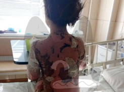 У семилетней девочки отслоилась кожа после лечения под Воронежем