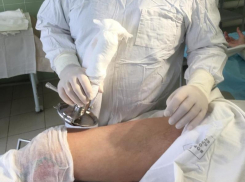 Воронежские врачи спасли мужчину с глубокими ожогами 