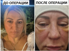 «Я не подопытный кролик»: пациентка рассказала о жутких последствиях операций в воронежской клинике