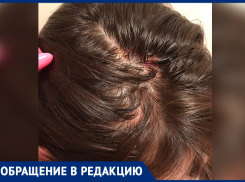 Кроваво-гнойными волдырями покрылась голова девушки после похода в студию красоты в Воронеже