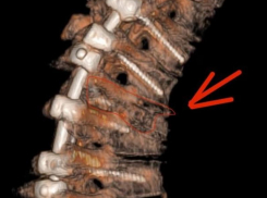 Воронежец получил серьезнейшую травму, нырнув в реку