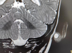 Врачи удалили дермоидную кисту из уха 8-месячной малышки в Воронеже 