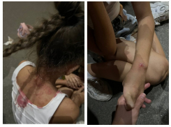 Оставили ребенка в крови: подростки сбили на самокате 8-летнюю девочку и убежали в Воронеже 