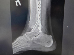 Дело закрыли: воронежец ищет свидетелей ДТП, в котором авто сломало ему ногу