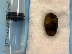 Метод удаления камней с сохранением желчного пузыря применяют в клинике «Доктор Альбрехт»