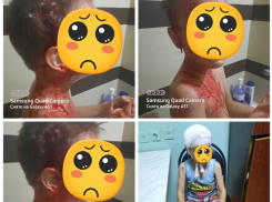 Мать показала рану на голове шестилетнего сына после нападения собаки под Воронежем