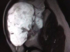  Гигантский нарост угрожал суставу: воронежские врачи спасли подростка