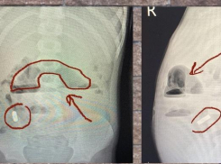 10 магнитов извлекли из брюшной полости 6-летнего малыша в Воронеже
