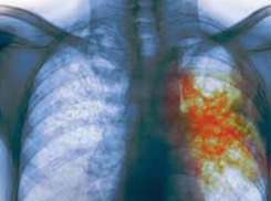 Опыт воронежских врачей в борьбе с туберкулезом приехали изучать специалисты ВОЗ