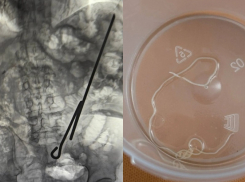 «Повезло, что был голоден»: паразита и самодельный инструмент вырезали из двух мужчин в Воронеже 