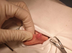 15-летнего подростка с редкой патологией прооперировали в воронежской больнице