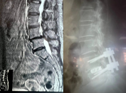 Воронежские медики вернули 61-летней пациентке возможность ходить без боли