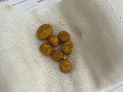 Пытавшегося вылечить кровь в моче настоями трав мужчину срочно прооперировали в Воронеже