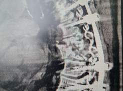 Сломанный позвоночник и угроза инвалидности: как в Воронеже поставили на ноги жертву ДТП