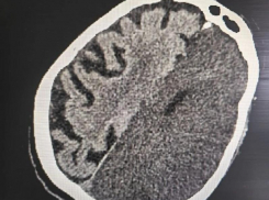 «Не было движений справа в теле»: врачи спасли жизнь пациентки с инсультом в Воронеже