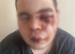 Сотрясение мозга вместо шаурмы получил 23-летний мужчина в Воронежской области