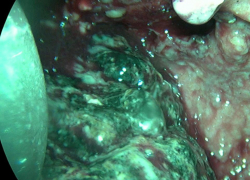 Оперировали через проколы: как воронежские хирурги вытащили с того света 26-летнего парня