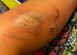 Жуткие последствия наезда мопеда показала девушка в Воронеже