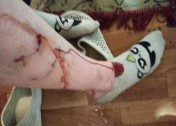 Жительница Воронежа сообщила о нападении собаки