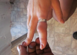 В Воронеже спасатели сняли кольцо с опухшего пальца девушки