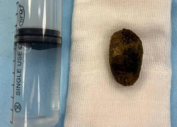 Метод удаления камней с сохранением желчного пузыря применяют в клинике "Доктор Альбрехт"