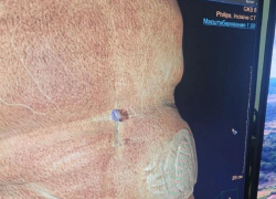 Огромную грыжу удалили воронежские врачи у 79-летнего мужчины в БСМП №8