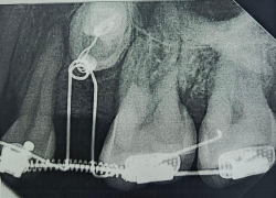 Взрослой пациентке вернули на место непрорезавшиеся зубы в Воронеже