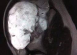  Гигантский нарост угрожал суставу: воронежские врачи спасли подростка