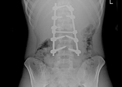 Воронежские врачи вернули 16-летнему подростку возможность ходить после тяжёлой травмы