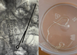 «Повезло, что был голоден»: паразита и самодельный инструмент вырезали из двух мужчин в Воронеже 