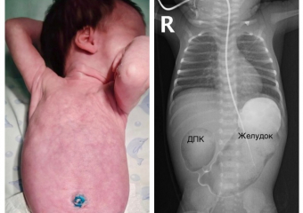 Врачи спасли новорожденную девочку с пороком кишечника в Воронеже