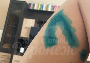 Последствия укуса бездомной собаки показала жительница Воронежа