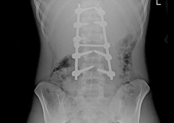 Воронежские врачи вернули 16-летнему подростку возможность ходить после тяжёлой травмы