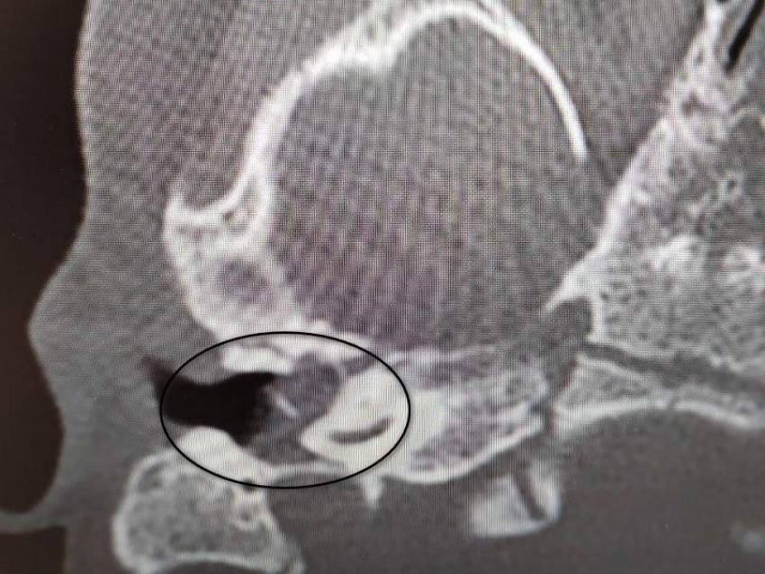 Врачи вылечили редкое заболевание у 2-летней девочки и сохранили ей слух