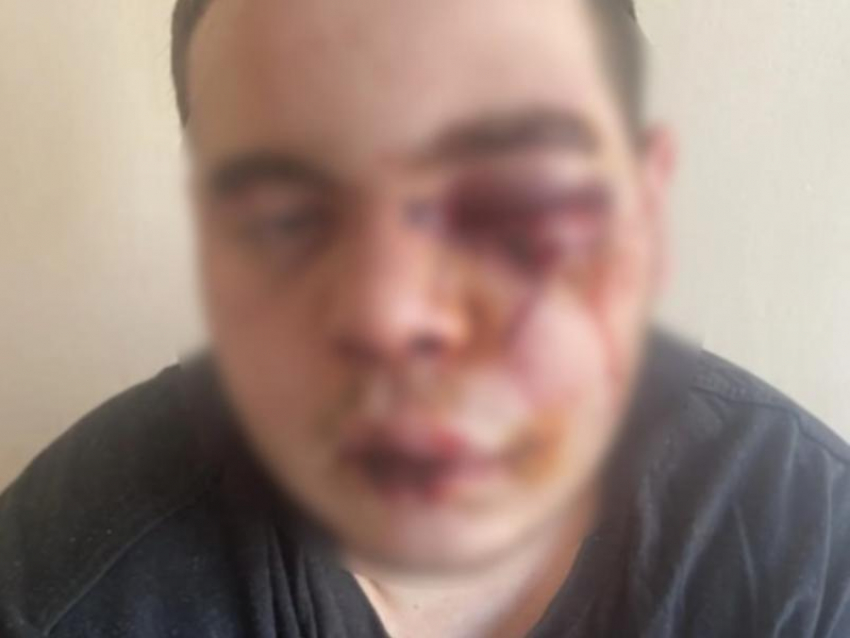 Сотрясение мозга вместо шаурмы получил 23-летний мужчина в Воронежской области