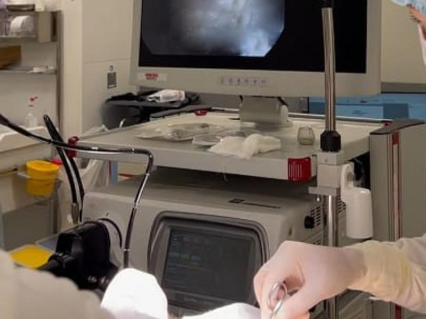 Воронежцу удалили 1,5-сантиметровую опухоль из нижней части глотки в онкоцентре