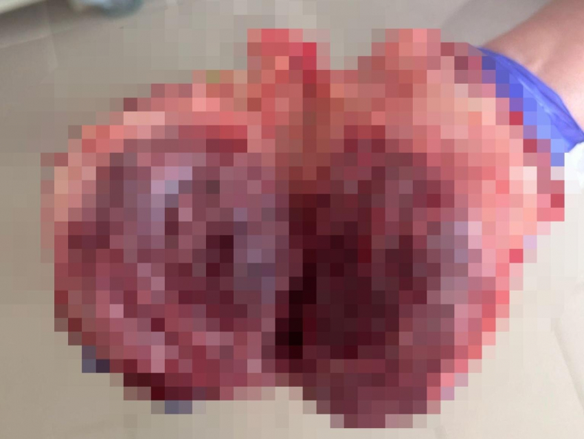 Сильная боль внизу живота привела к срочной операции в Воронеже