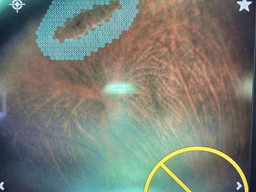 16-летнего белгородского спортсмена с аллергией на анестетики спасли от потери зрения в Воронеже 