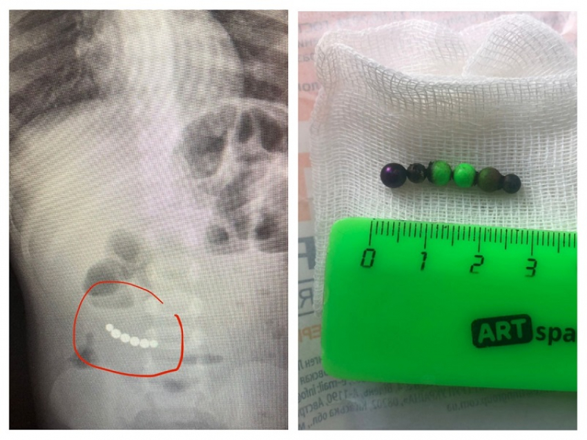 Проглотившего магнитные шарики 5-летнего мальчика спасли врачи в Воронеже
