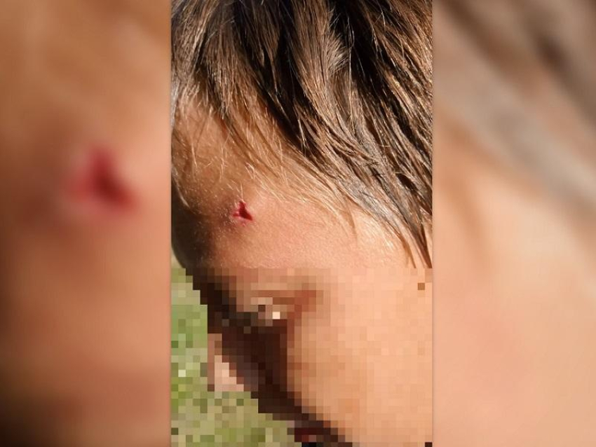 Мальчику из воронежского райцентра разбили голову камнем за громкую музыку