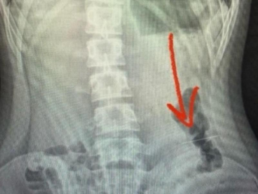 Ребенок проглотил иголку в Воронеже