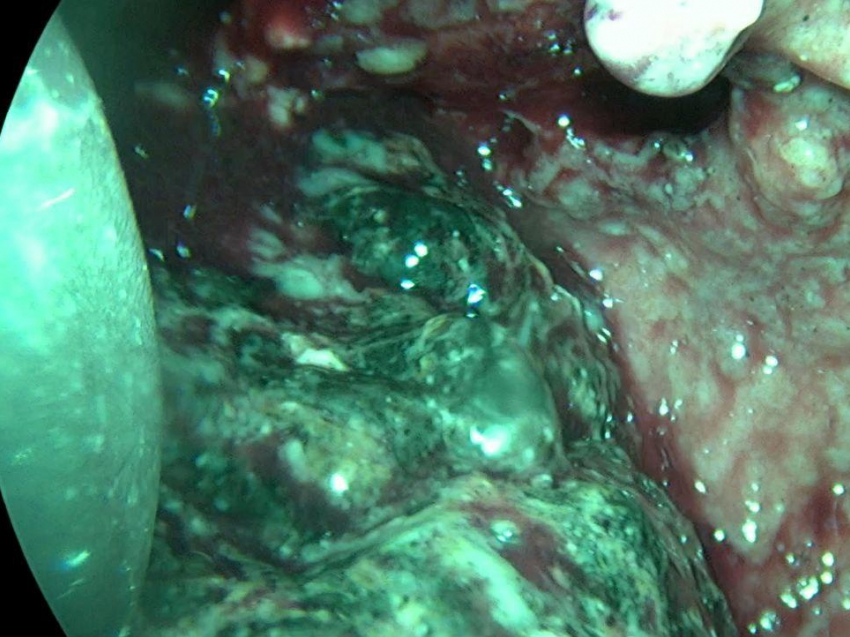 Оперировали через проколы: как воронежские хирурги вытащили с того света 26-летнего парня